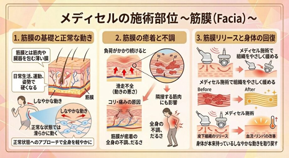 メディセルの施術部位。筋膜についてまとめた画像。