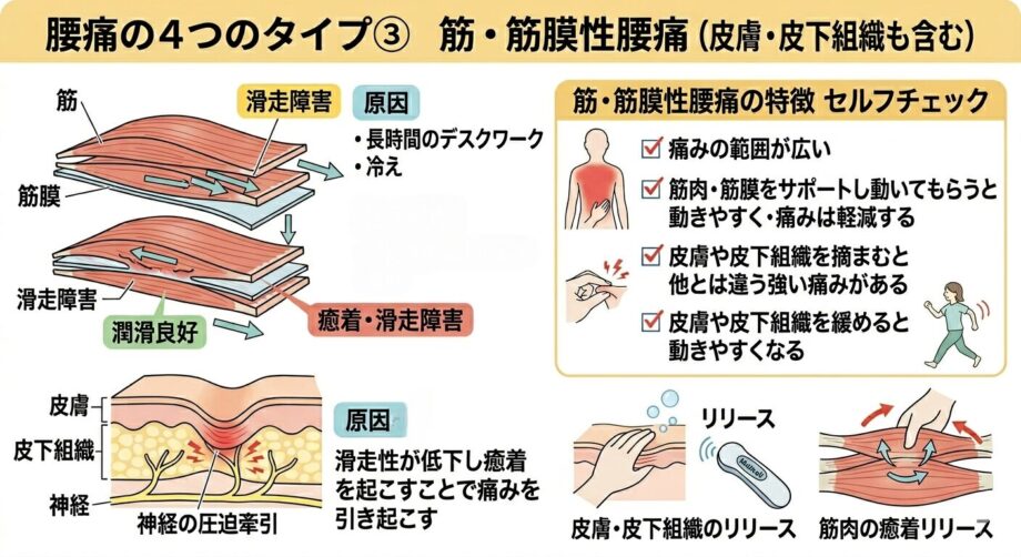 筋・筋膜性の腰痛をまとめた画像。
